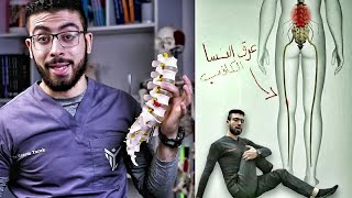 علاج ألم وتنميل المؤخرة والرجل بتمرين واحد فقط | عرق النسا الكاذب