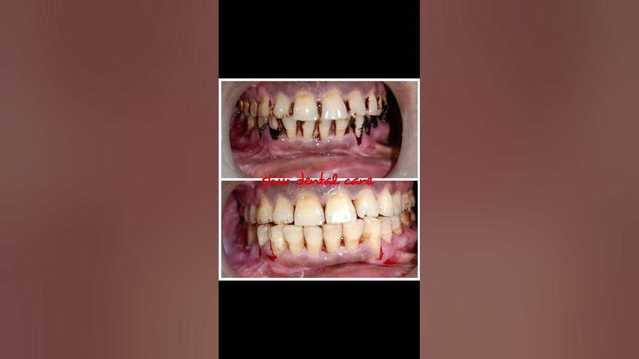 pan-masala-gutka-chewer-osmf-teeth-cleaning-patient-education