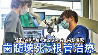 歯の神経が壊死 ズキズキと痛む《ＭＴＡ歯の神経治療２年後に歯髄壊死》当院の根管治療の様子。その原因は？かみあわせ！？