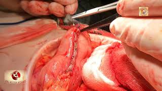 Open Transverse Colon Resection,D3/Комбинированная резекция поперечноободочной кишки Д3