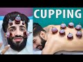 Wet cupping therapy  hijama for skin care  my first hijama cupping