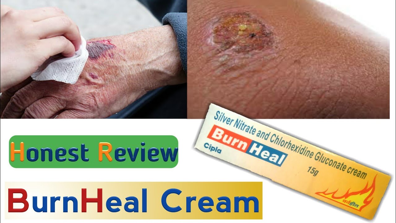 Burn Heal Cream Review Burn Wound Care In Hindi Silver Nitrate burn-heal-cream-review-burn-wound-care-in-hindi-silver-nitrate
