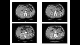 Stage 1b RCC: Partial Nephrectomy the New Standard-CON Didier Jacqmin, M.D.