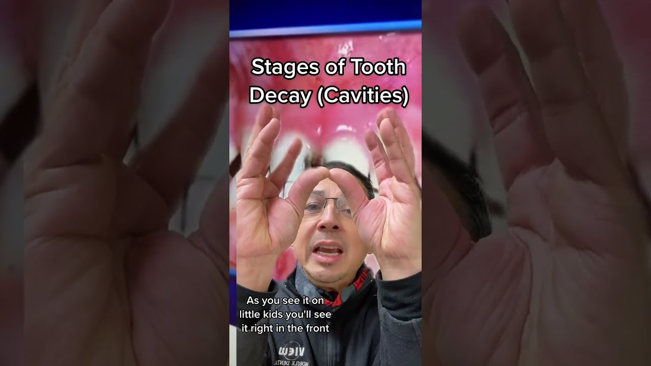 Explaining The Stages Of Tooth Decay Cavities View Mobile Dental