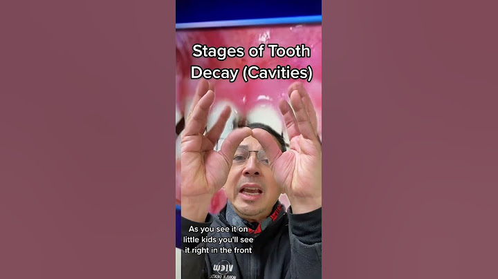 Explaining the Stages of Tooth Decay (Cavities) | View Mobile Dental