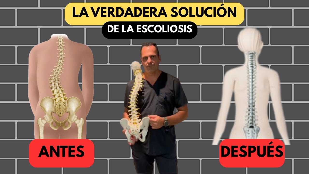Si tienes ESCOLIOSIS esto te INTERESA 