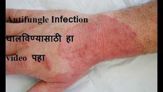 zathrin syrup uses in marathi screenshot 1