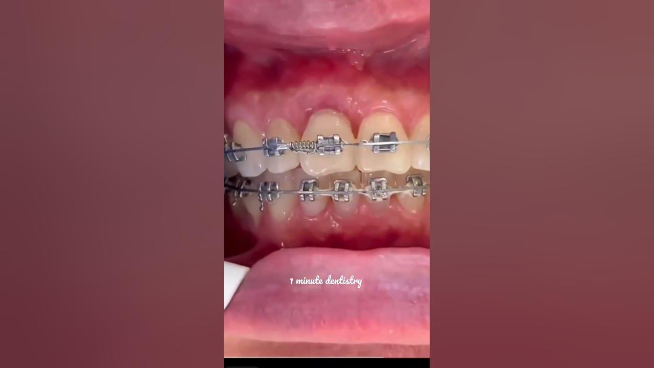 BRACES Procedure YouTube
