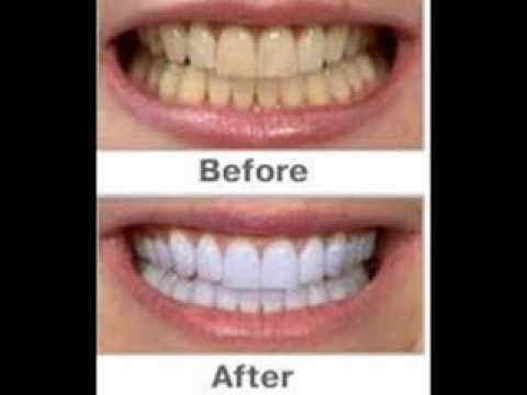  Whitening teeth whitening before and after great tip here - youtube