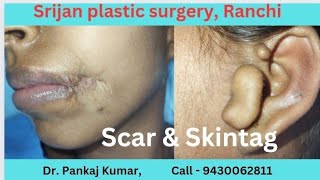 Scar treatment in Ranchi| Treatment of facial scar and skin tag ( group Vll  cleft)