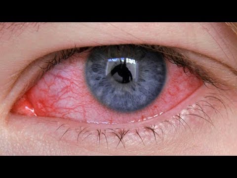 فيديو: كيفية ازالة احمرار العين
