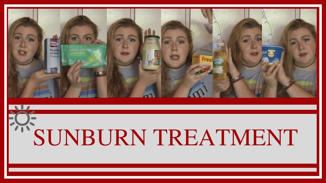 SUNBURN TREATMENT HACKS / SUMMER SERIES🌞 