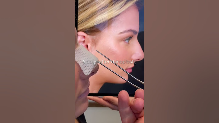 Splint removal 6 days after rhinoplasty