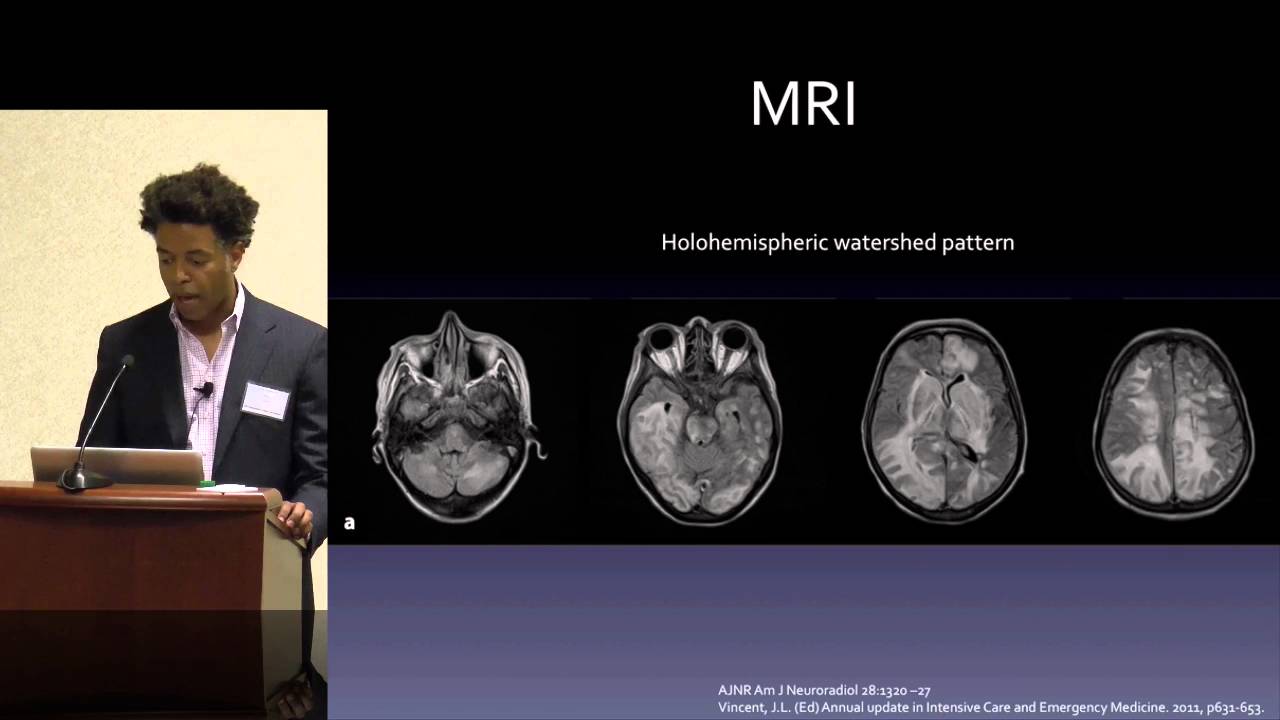 icu معنى Posterior Reversible Encephalopathy Syndrome (PRES): Who, What When? by Tommy T. Thomas, MD, PhD