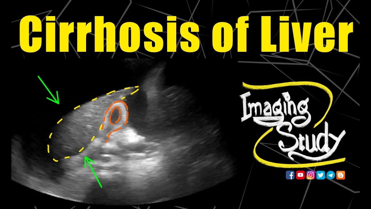 case study cirrhosis of the liver