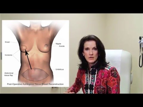 Options for Breast Reconstruction after Mastectomy? Ask the Doctor