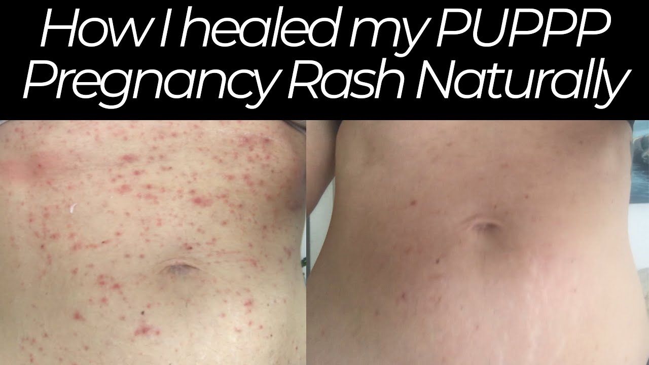 How I Healed my PUPPP Pregnancy Rash Naturally 