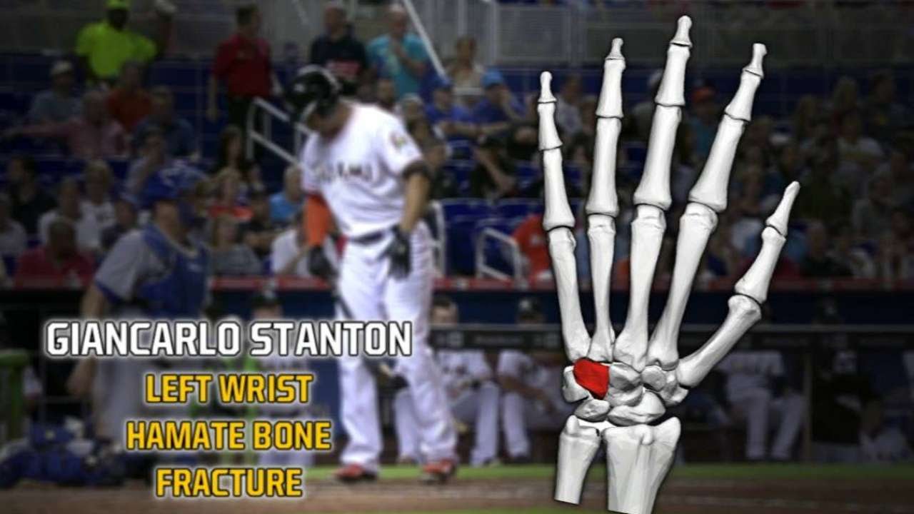 Marlins' Giancarlo Stanton out 4-6 weeks with broken left hand