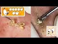 Large closed comedones  whiteheads extraction