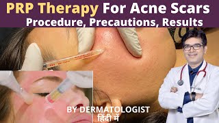 PRP Treatment For Face, Acne Scars | PRP Therapy | Platelet Rich Plasma Treatment In Jaipur