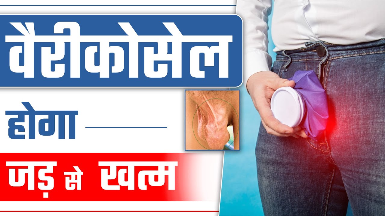 वैरीकोसेल होगा जड़ से खत्म | वैरीकोसेल और अंडकोष की सुजन बिना सर्जरी के ठीक करे  | Dr Health