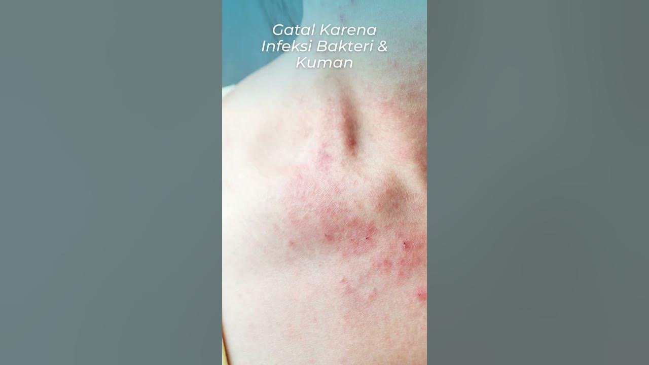 yuk kenali apa saja penyebab yang membuat kulitmu ruam gatal-gatal