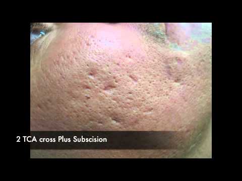 TCA CROSS for acne scars