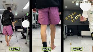 청소년 디스크탈출 후 비골신경마비 치료사례 (10주 완치)