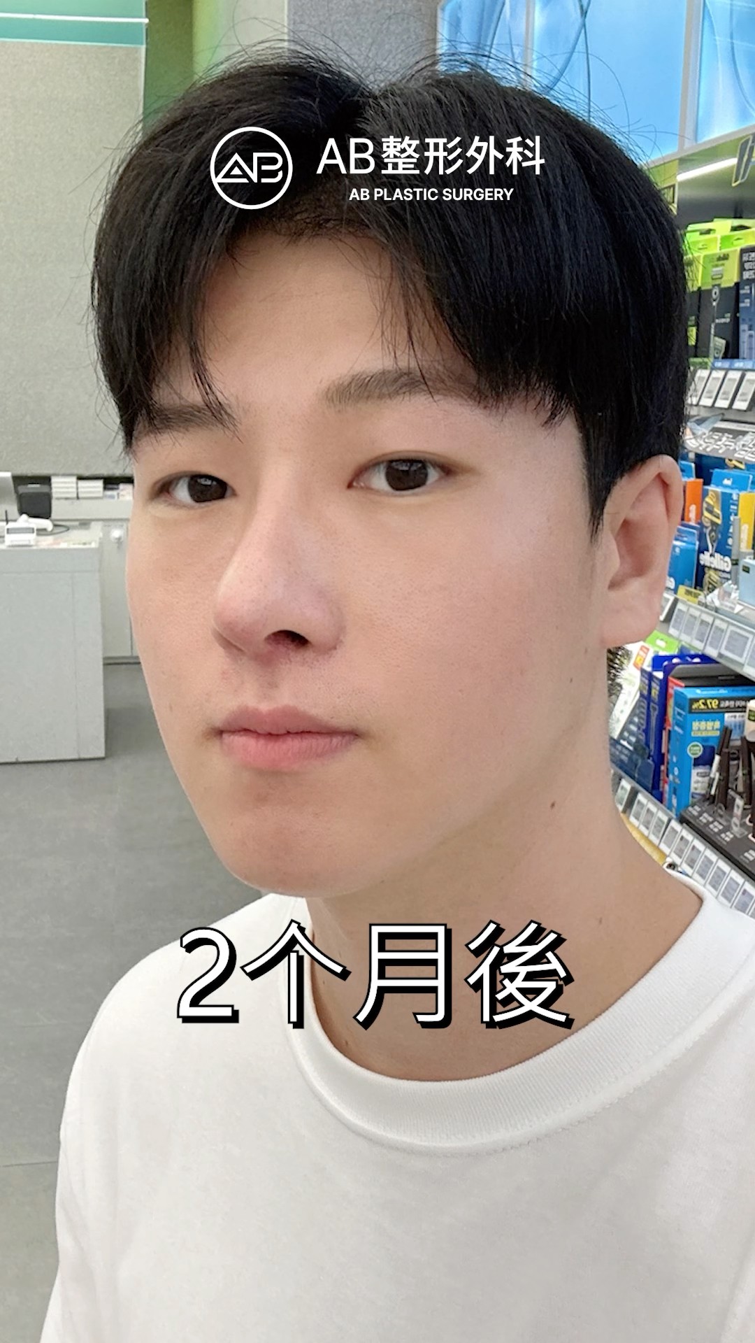 從斯文到帥氣！眼鼻整形前後大對比 #shorts