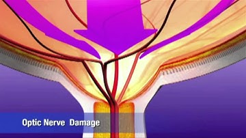 Trabectome Animation (1:29 min)
