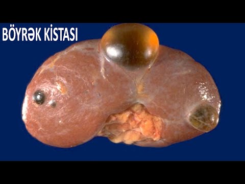 Video: İtlərdə Bir çox Kistin Yaratdığı Böyrək Xəstəliyi