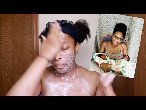 How to Get Rid of that PREGNANCY MASK | Chloasma/Melasma (Pictures Included)