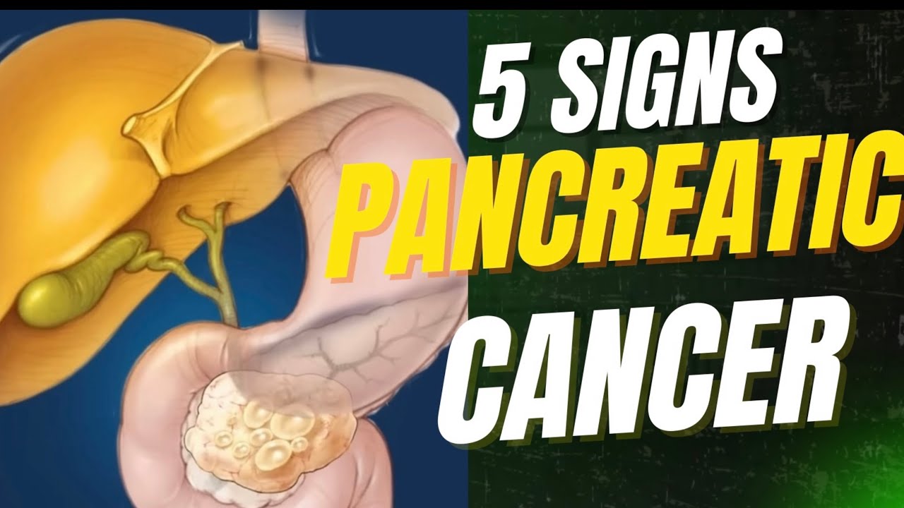 5 Signs of Pancreatic Cancer| What You Need to Know - YouTube
