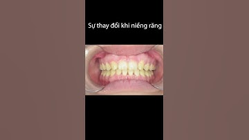 Hình ảnh trước và sau khi niềng răng móm