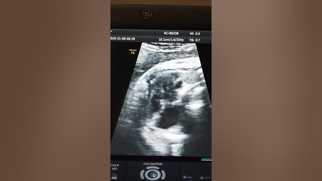Endocardial cushion defect, Fetal ultrasound YouTube