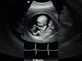 18-Weeks Ultrasound Scan #shorts