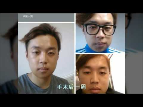 韩国整形前后对比照