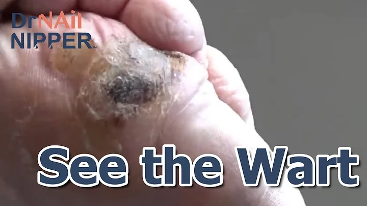 Throwback - Emilys Wart
