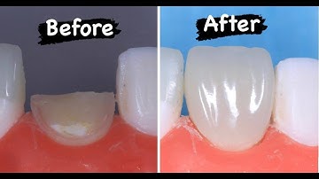 direct composite veneer step by step (with audio explanation).