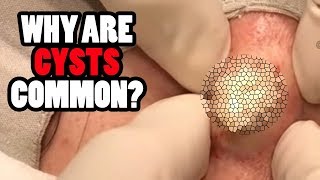 Why Back Cysts Are So Common!  Pimples and Cysts