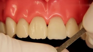 class IV composite preparation and restoration in one visit