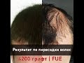 Результат по пересадки волос 4200 графт методом FUE / Soch peresadkasi natijasi 8 oy.