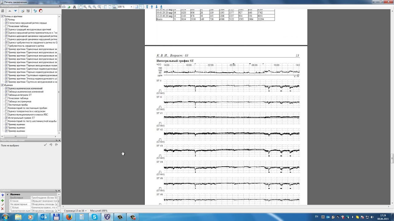 KTResult 3 ST T ишемические аритмии
