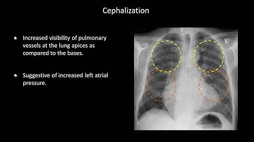 How to Interpret a Chest X Ray Lesson 7   Diffuse Lung Processes
