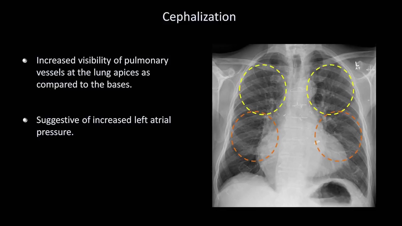 How to Interpret a Chest X Ray Lesson 7 Diffuse Lung Processes YouTube