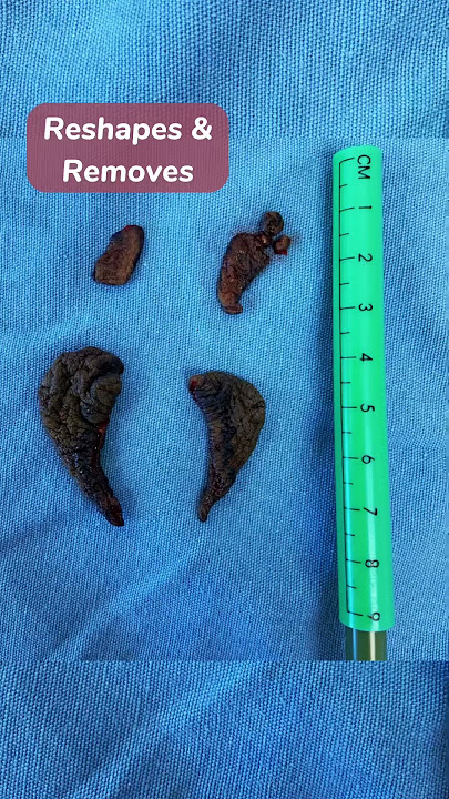 Female intimate surgeries with 👨🏻‍⚕️Dr.Saldaña #gynecologist #surgery #womenhealth #vaginalhealth