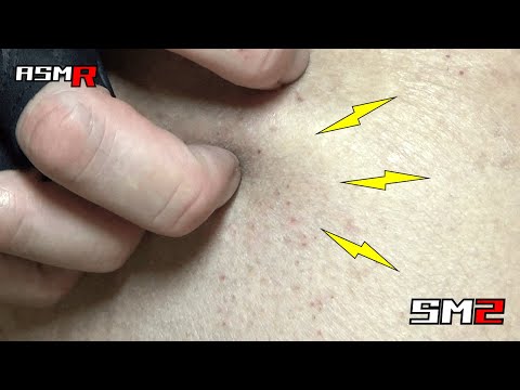 【見る痒み止め】アトピー性皮膚炎ASMR/超痒い乾燥皮膚を爪でボリボリ掻く音/癒し/リラックス効果/睡眠導入/マッサージ