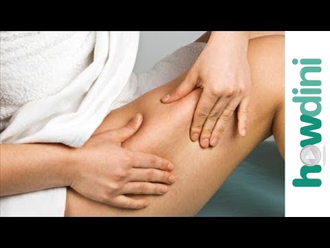 What causes cellulite?