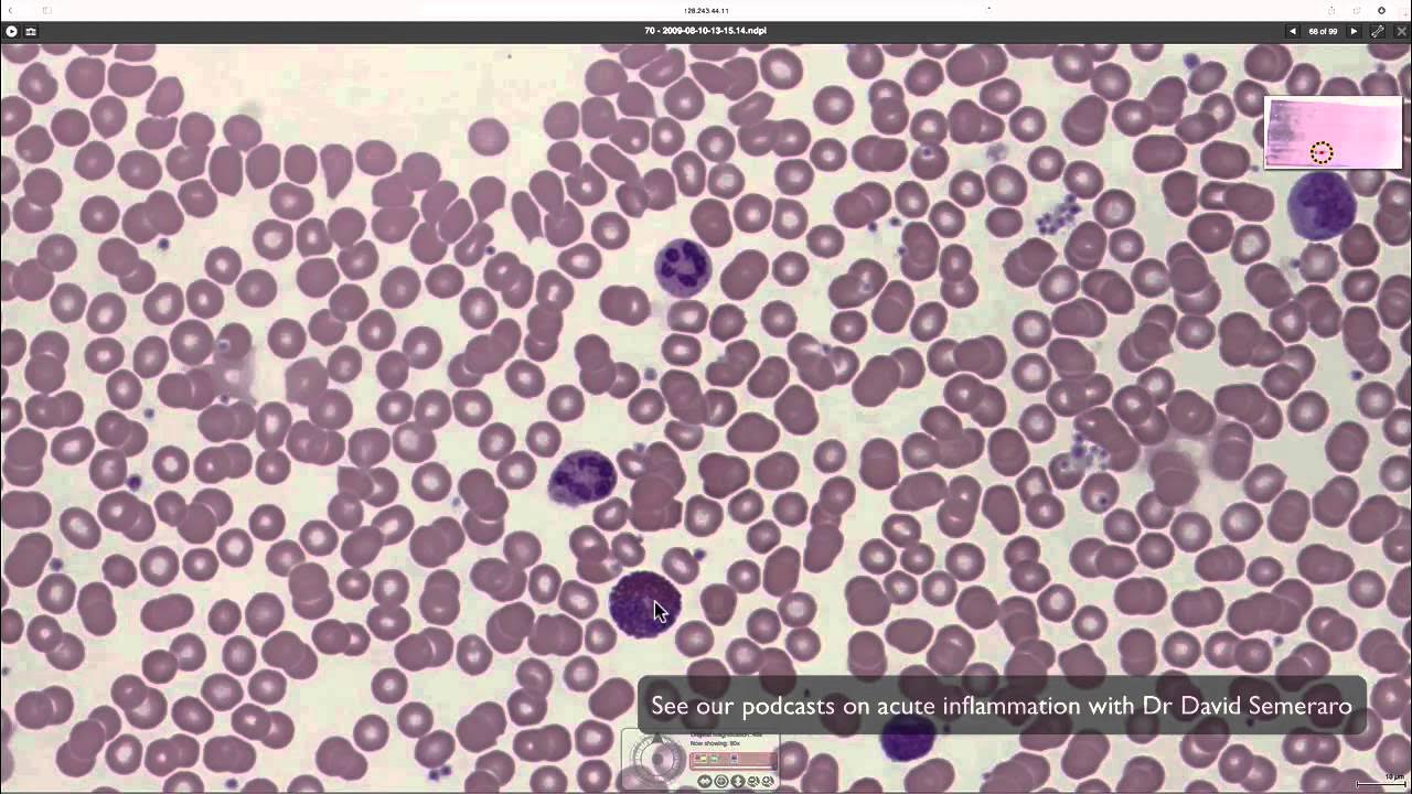 Анализ крови под микроскопом What blood looks like down the microscope - YouTube