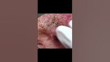 Who needs a Mr. Wilson break? 🙋🏻‍♀️ #drpimplepopper